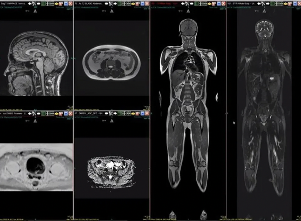 Whole Body MRI Images